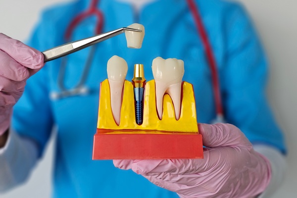 Can Dental Implants Replace Molar Teeth?