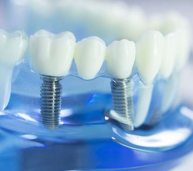 Palm Beach Gardens Dental Implants