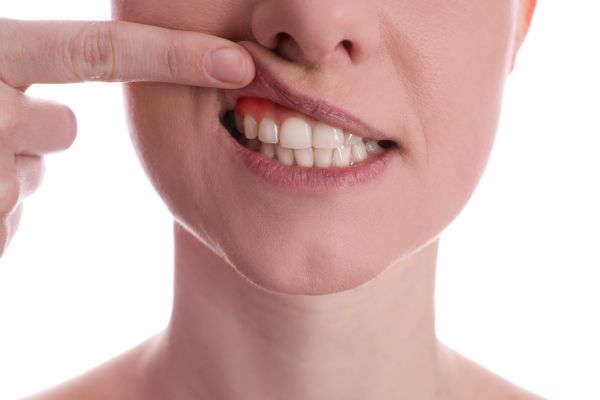 Reversing Gingivitis With Early Gum Disease Treatment
