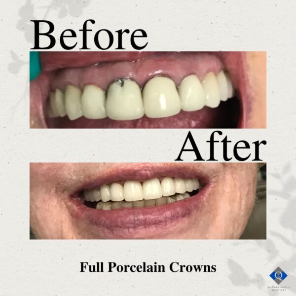 Dentist in Palm Beach Gardens, FL Smile Gallery Quasha Dentistry