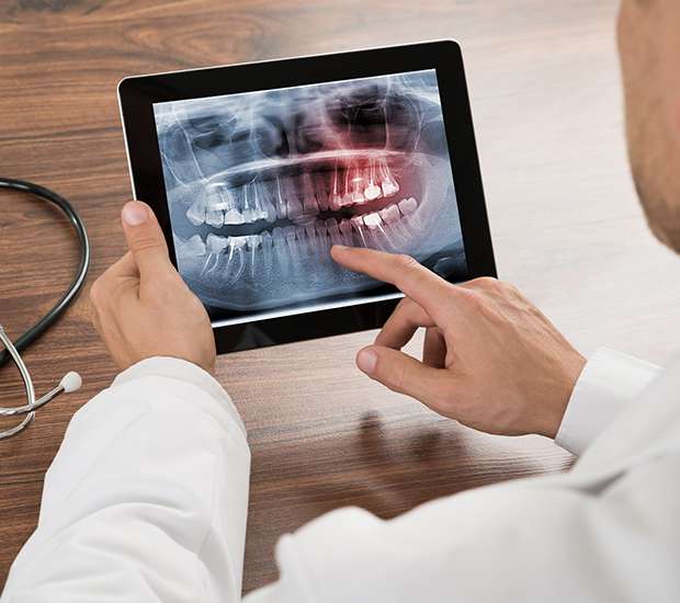 Palm Beach Gardens Types of Dental Root Fractures